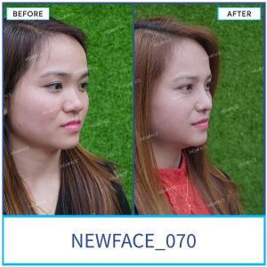 Hình ảnh nâng mũi trước sau Bs Trần Phương - Ca 70