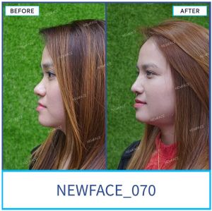 Hình ảnh nâng mũi trước sau Bs Trần Phương - Ca 70