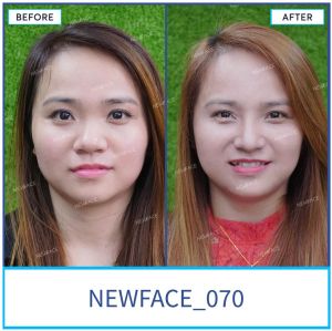 Hình ảnh nâng mũi trước sau Bs Trần Phương - Ca 70