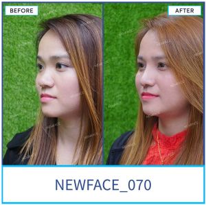 Hình ảnh nâng mũi trước sau Bs Trần Phương - Ca 70