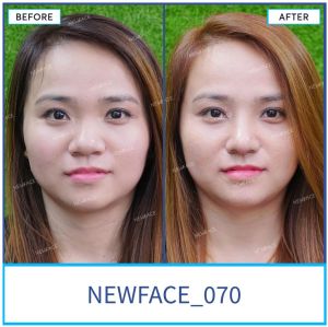 Hình ảnh nâng mũi trước sau Bs Trần Phương - Ca 70