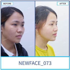 Hình ảnh nâng mũi trước sau Bs Trần Phương - Ca 73