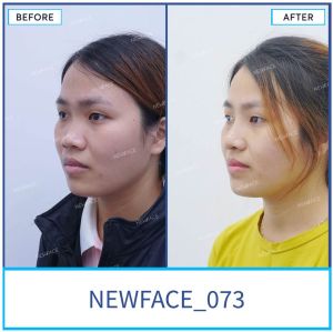 Hình ảnh nâng mũi trước sau Bs Trần Phương - Ca 73