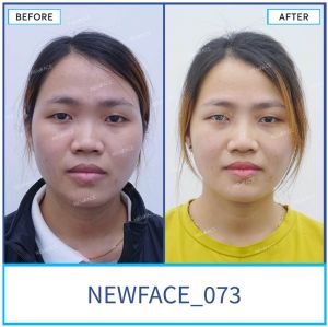 Hình ảnh nâng mũi trước sau Bs Trần Phương - Ca 73