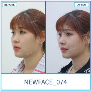 Hình ảnh nâng mũi trước sau Bs Trần Phương - Ca 74