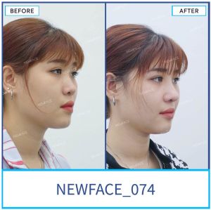 Hình ảnh nâng mũi trước sau Bs Trần Phương - Ca 74