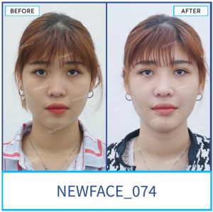 Hình ảnh nâng mũi trước sau Bs Trần Phương - Ca 74