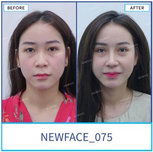 Hình ảnh nâng mũi trước sau Bs Trần Phương - Ca 75