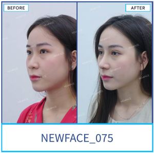 Hình ảnh nâng mũi trước sau Bs Trần Phương - Ca 75