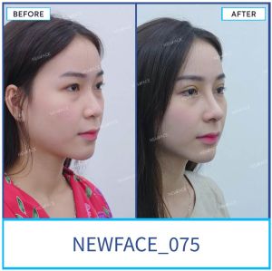 Hình ảnh nâng mũi trước sau Bs Trần Phương - Ca 75