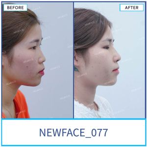 Hình ảnh nâng mũi trước sau Bs Trần Phương - Ca 77