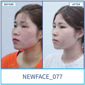 Hình ảnh nâng mũi trước sau Bs Trần Phương - Ca 77