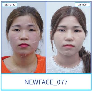 Hình ảnh nâng mũi trước sau Bs Trần Phương - Ca 77