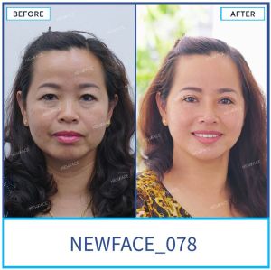 Hình ảnh nâng mũi trước sau Bs Trần Phương - Ca 78