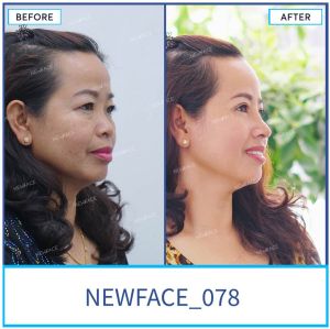 Hình ảnh nâng mũi trước sau Bs Trần Phương - Ca 78