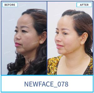 Hình ảnh nâng mũi trước sau Bs Trần Phương - Ca 78