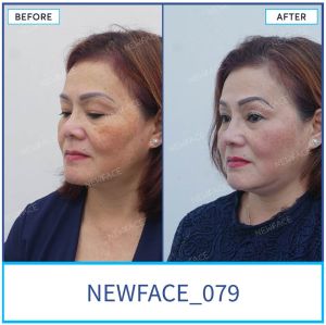 Hình ảnh nâng mũi trước sau Bs Trần Phương - Ca 79