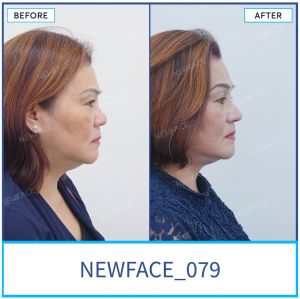 Hình ảnh nâng mũi trước sau Bs Trần Phương - Ca 79