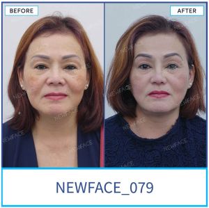 Hình ảnh nâng mũi trước sau Bs Trần Phương - Ca 79