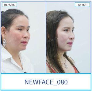 Hình ảnh nâng mũi trước sau Bs Trần Phương - Ca 80