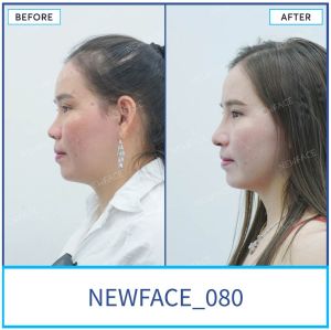 Hình ảnh nâng mũi trước sau Bs Trần Phương - Ca 80