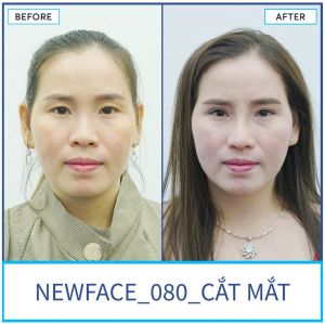 Hình ảnh nâng mũi trước sau Bs Trần Phương - Ca 80