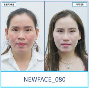 Hình ảnh nâng mũi trước sau Bs Trần Phương - Ca 80
