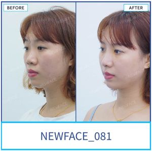 Hình ảnh nâng mũi trước sau Bs Trần Phương - Ca 81