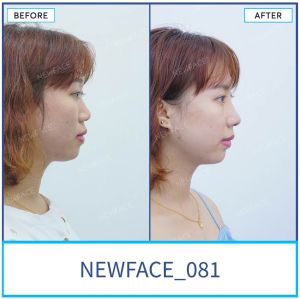 Hình ảnh nâng mũi trước sau Bs Trần Phương - Ca 81