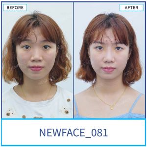 Hình ảnh nâng mũi trước sau Bs Trần Phương - Ca 81
