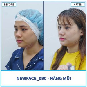 Hình ảnh nâng mũi trước sau Bs Trần Phương - Ca 90