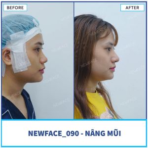 Hình ảnh nâng mũi trước sau Bs Trần Phương - Ca 90