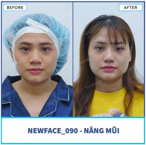 Hình ảnh nâng mũi trước sau Bs Trần Phương - Ca 90