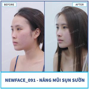 Hình ảnh nâng mũi trước sau Bs Trần Phương - Ca 91