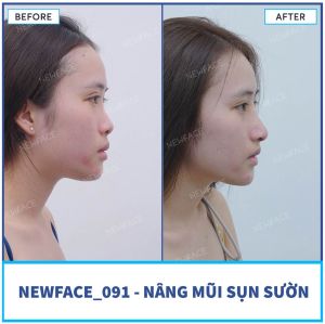 Hình ảnh nâng mũi trước sau Bs Trần Phương - Ca 91