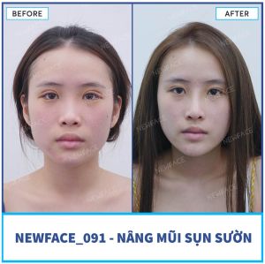 Hình ảnh nâng mũi trước sau Bs Trần Phương - Ca 91
