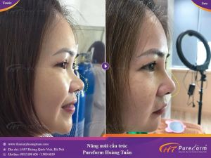 Hình ảnh nâng mũi trước sau thẩm mỹ Hoàng Tuấn - Ca 1
