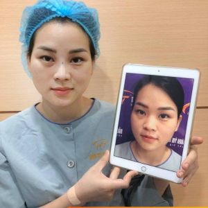 Hình ảnh nâng mũi trước sau thẩm mỹ Hoàng Tuấn - Ca 2