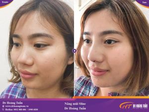 Hình ảnh nâng mũi trước sau thẩm mỹ Hoàng Tuấn - Ca 3