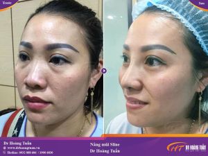 Hình ảnh nâng mũi trước sau thẩm mỹ Hoàng Tuấn - Ca 4