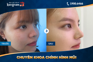 Hình ảnh nâng mũi trước sau thẩm mỹ Kangnam - Ca 10