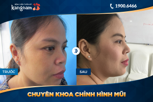 Hình ảnh nâng mũi trước sau thẩm mỹ Kangnam - Ca 11