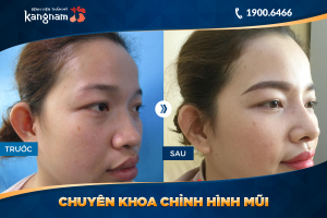 Hình ảnh nâng mũi trước sau thẩm mỹ Kangnam - Ca 12