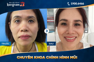 Hình ảnh nâng mũi trước sau thẩm mỹ Kangnam - Ca 13