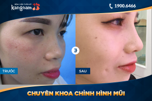 Hình ảnh nâng mũi trước sau thẩm mỹ Kangnam - Ca 14