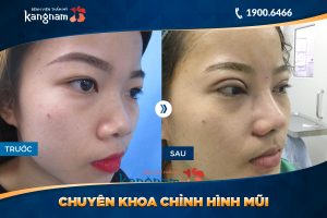 Hình ảnh nâng mũi trước sau thẩm mỹ Kangnam - Ca 15