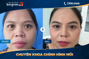 Hình ảnh nâng mũi trước sau thẩm mỹ Kangnam - Ca 16