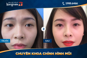 Hình ảnh nâng mũi trước sau thẩm mỹ Kangnam - Ca 17
