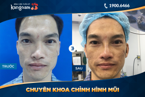 Hình ảnh nâng mũi trước sau thẩm mỹ Kangnam - Ca 18