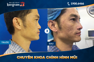 Hình ảnh nâng mũi trước sau thẩm mỹ Kangnam - Ca 18
